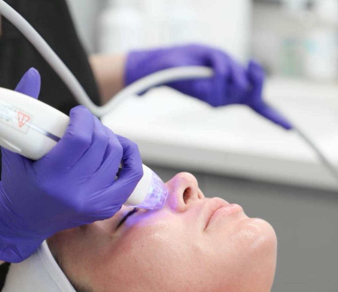 rf microneedling treatment