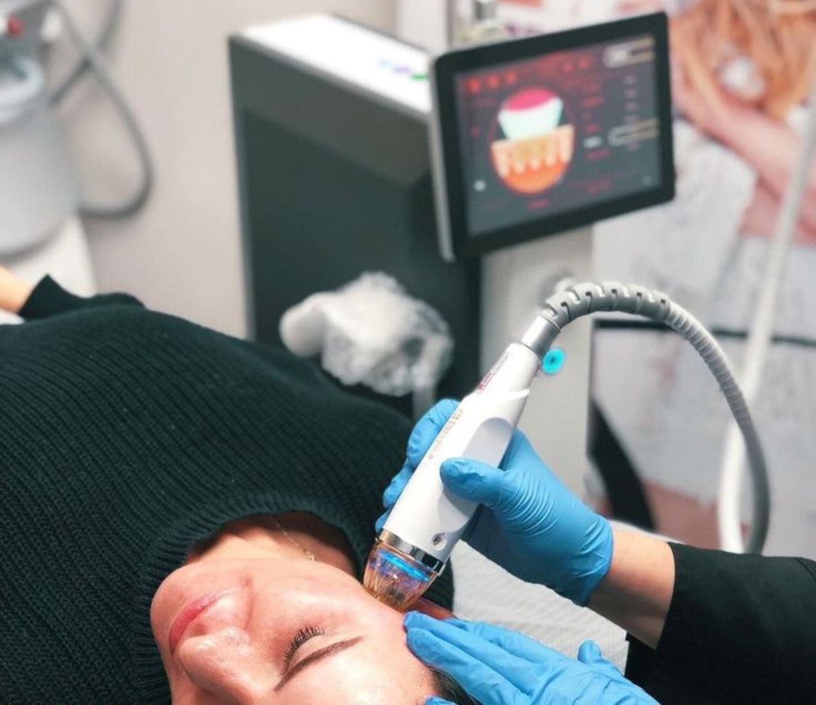 rf microneedling treatment