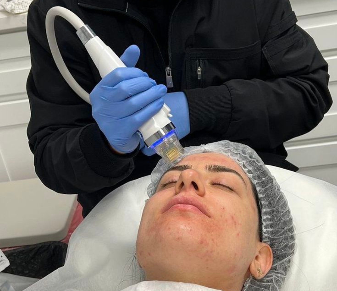 rf microneedling treatment