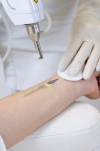 someone getting their tattoo remove