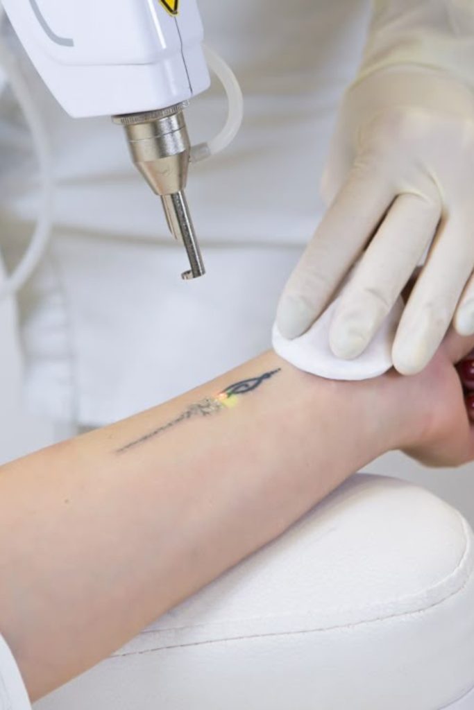 someone getting their tattoo remove